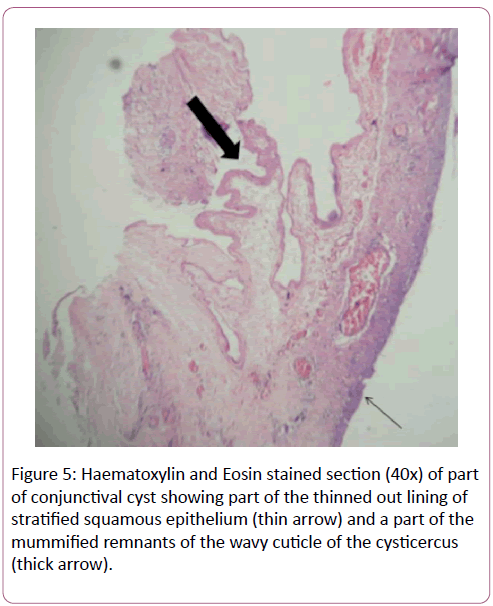 eye-cataract-surgery-Eosin-stained