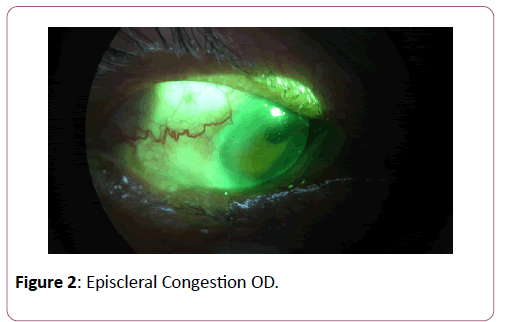 eye-cataract-surgery-Episcleral-Congestion