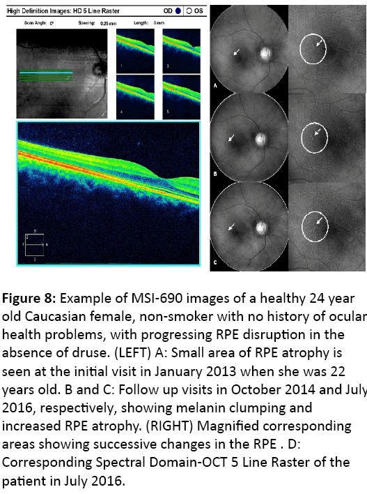 eye-cataract-surgery-Example-MSI-690-images