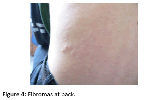 eye-cataract-surgery-Fibromas-back