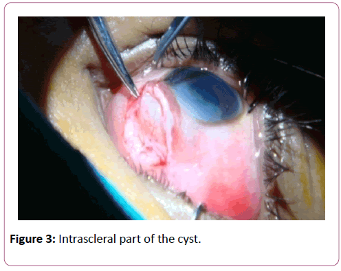 eye-cataract-surgery-Intrascleral-part
