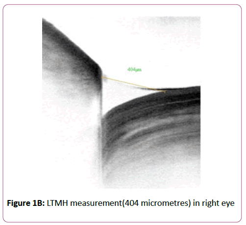 eye-cataract-surgery-LTMH-measurement