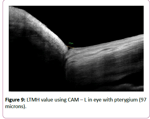 eye-cataract-surgery-LTMH-value