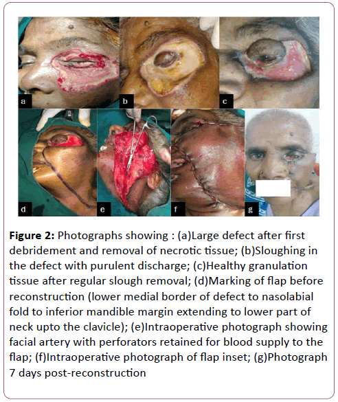 eye-cataract-surgery-Large-defect