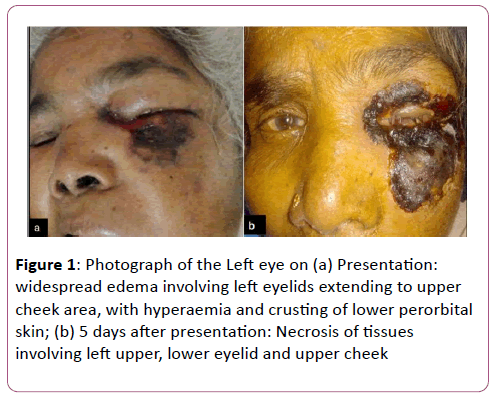 eye-cataract-surgery-Left-eye