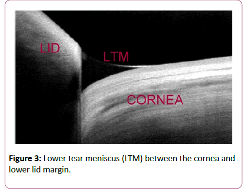 eye-cataract-surgery-Lower-tear