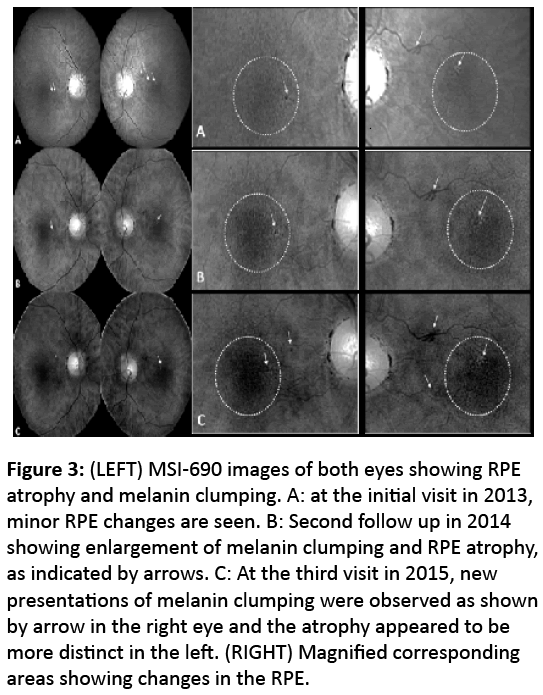 eye-cataract-surgery-MSI-690-images-both-eyes