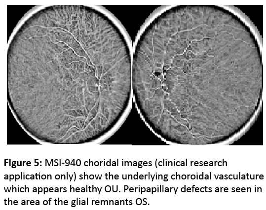 eye-cataract-surgery-MSI-940-choridal-images