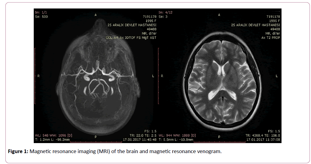 eye-cataract-surgery-Magnetic-resonance