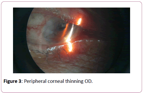 eye-cataract-surgery-Peripheral-corneal