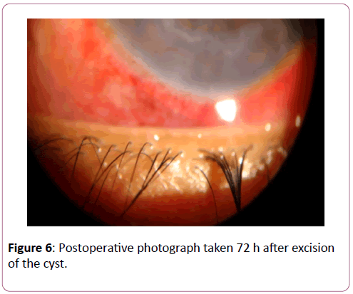 eye-cataract-surgery-Postoperative-photograph