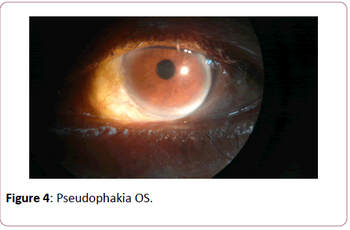 eye-cataract-surgery-Pseudophakia-OS