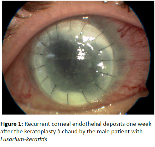 eye-cataract-surgery-Recurrent-corneal