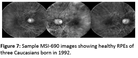 eye-cataract-surgery-Sample-MSI-690-images