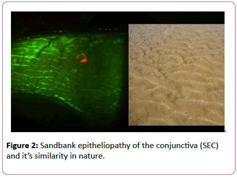 eye-cataract-surgery-Sandbank-epitheliopathy