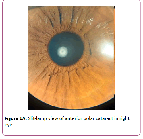 eye-cataract-surgery-Slit-lamp