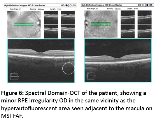 eye-cataract-surgery-Spectral-Domain-OCT