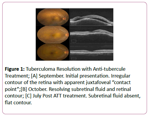 eye-cataract-surgery-Tuberculoma-Resolution