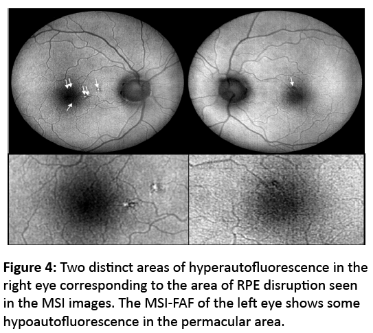 eye-cataract-surgery-Two-distinct-areas-hyperautofluorescence