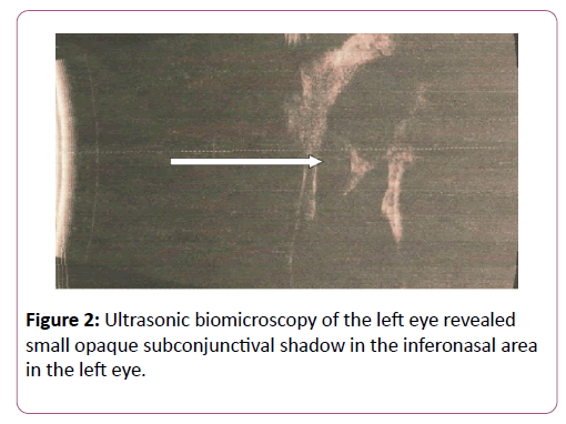 eye-cataract-surgery-Ultrasonic-biomicroscopy