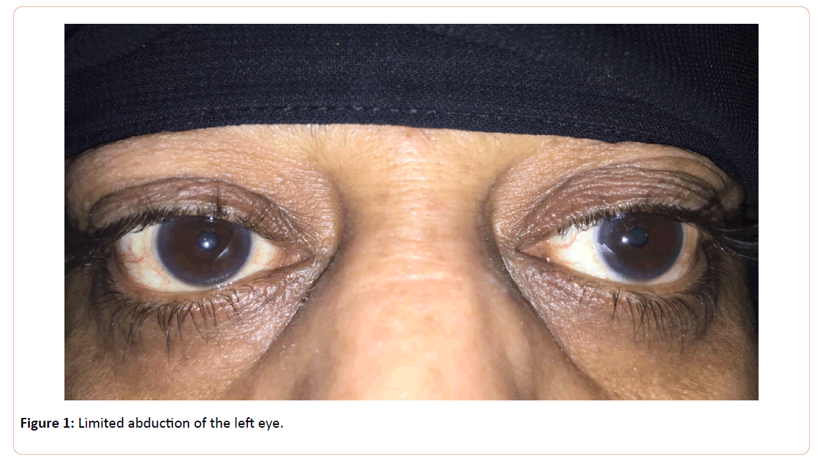eye-cataract-surgery-abduction-left-eye