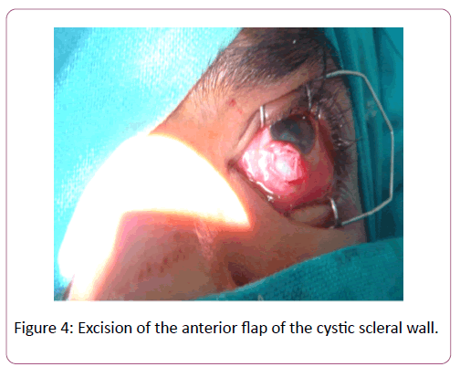 eye-cataract-surgery-anterior-flap