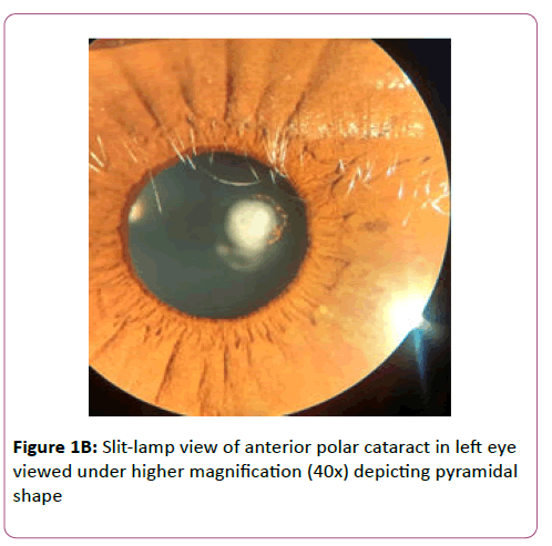 eye-cataract-surgery-anterior-polar