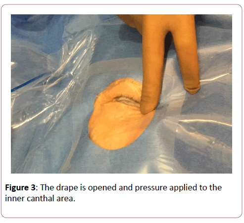 eye-cataract-surgery-canthal-area