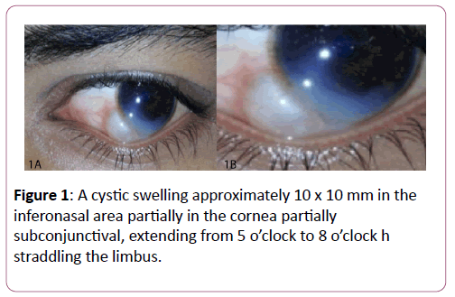 eye-cataract-surgery-cystic-swelling
