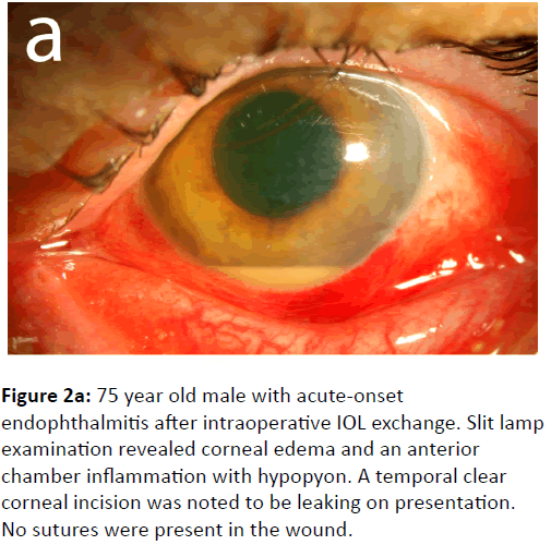eye-cataract-surgery-endophthalmitis-intraoperative