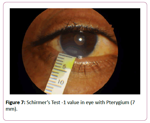 eye-cataract-surgery-eye-Pterygium