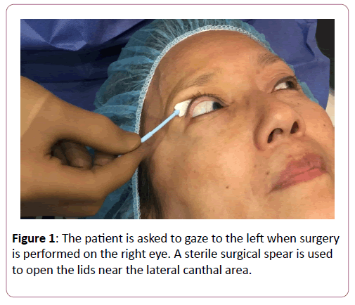 eye-cataract-surgery-lateral-canthal