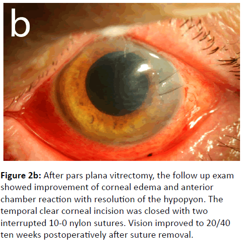 eye-cataract-surgery-pars-plana-vitrectomy