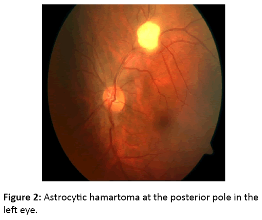 eye-cataract-surgery-pole-left-eye
