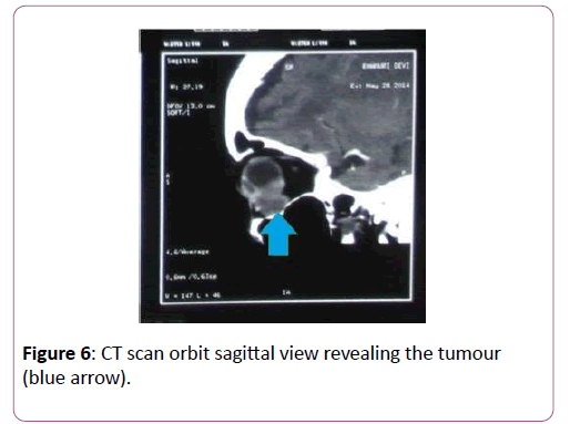 eye-cataract-surgery-sagittal-view