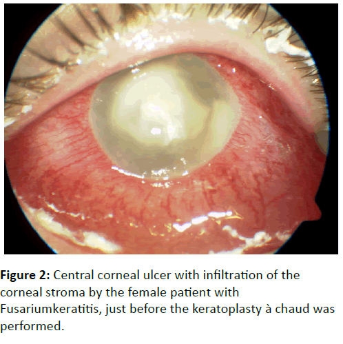 eye-cataract-surgery-stroma-female-patient
