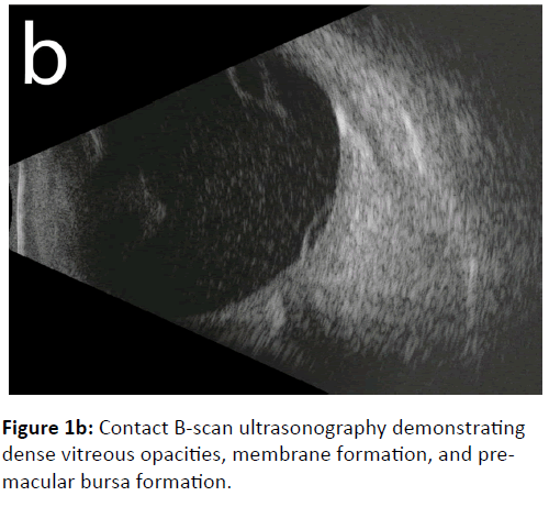 eye-cataract-surgery-ultrasonography-demonstrating