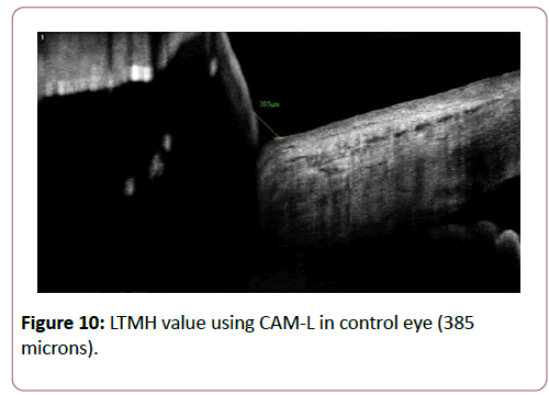 eye-cataract-surgery-value-using