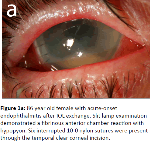 eye-cataract-surgery-year-old-female-acute-onset