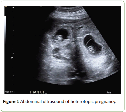 gynecology-obstetrics-Abdominal-ultrasound-heterotopic