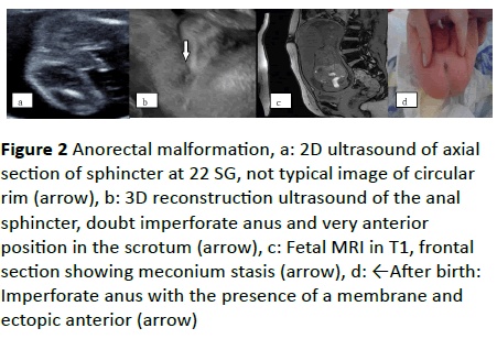 gynecology-obstetrics-Anorectal-malformation