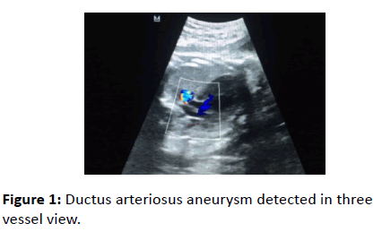 gynecology-obstetrics-Ductus-arteriosus