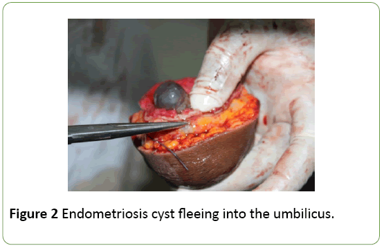 Natural Healing - Umbilical Endometriosis. Bleeding 🩸 through the