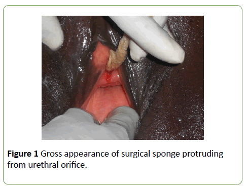 gynecology-obstetrics-Gross-appearance-surgical-sponge-protruding