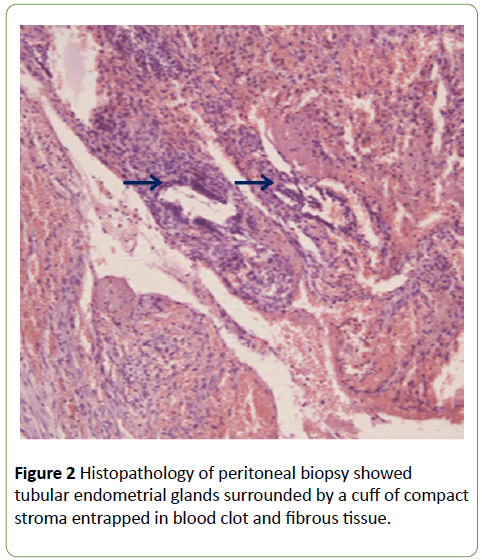 gynecology-obstetrics-Histopathology-peritoneal-biopsy