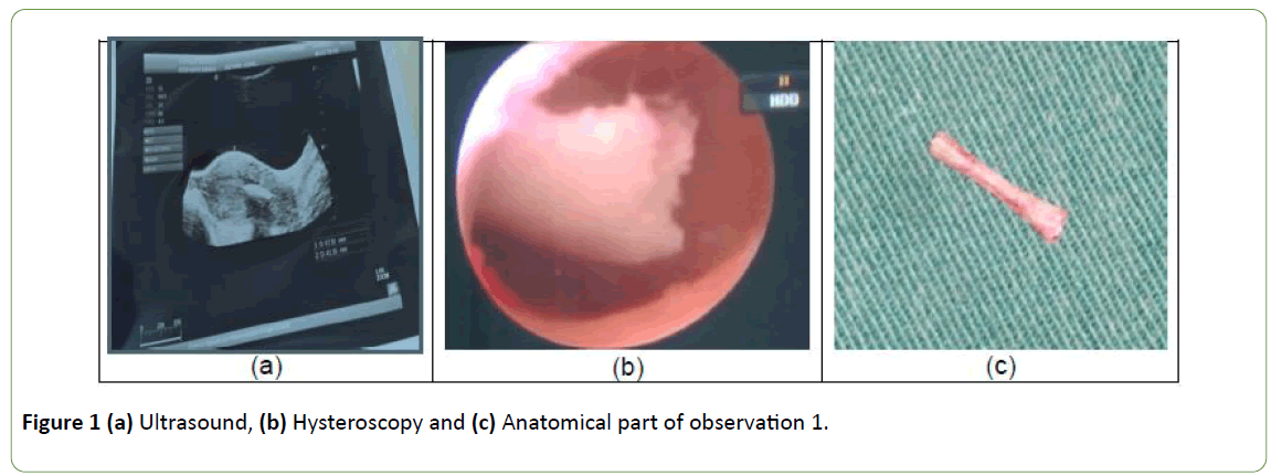 gynecology-obstetrics-Hysteroscopy