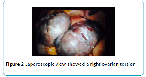 gynecology-obstetrics-Laparoscopic-right-ovarian-torsion