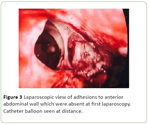 gynecology-obstetrics-Laparoscopic-view