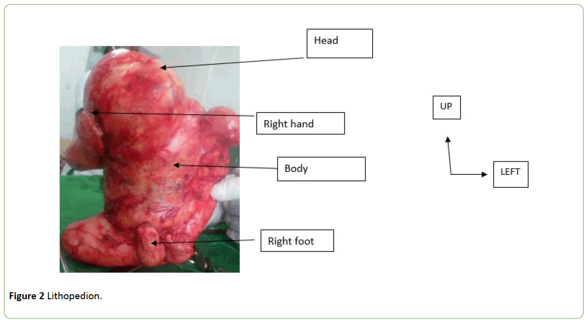 gynecology-obstetrics-Lithopedion