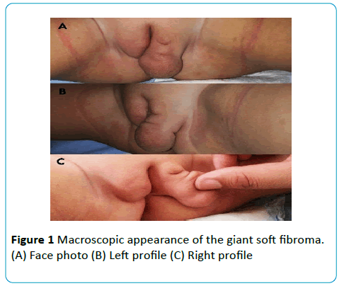 gynecology-obstetrics-Macroscopic-giant-soft-fibroma